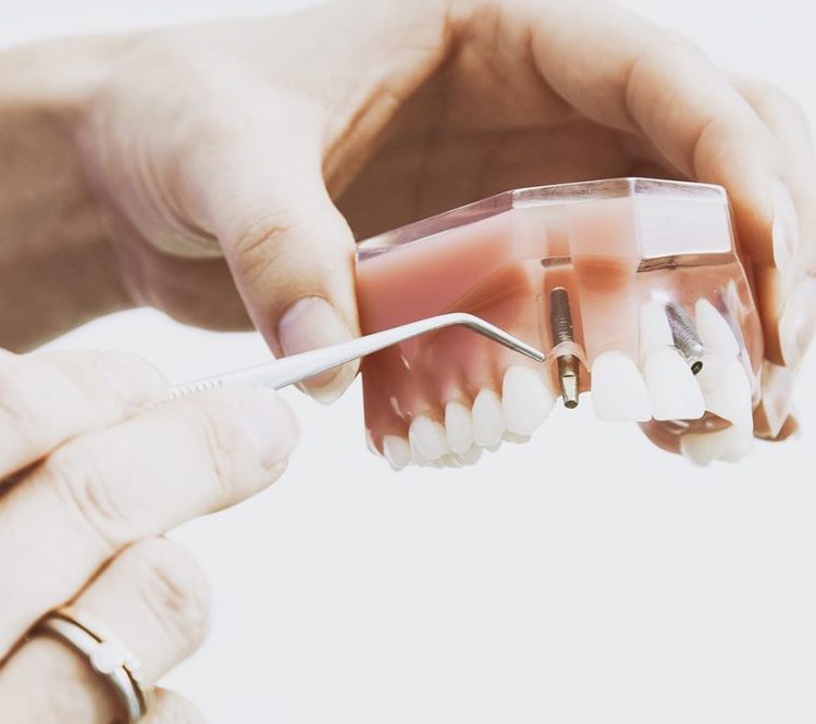 Beneficios de los implantes dentales