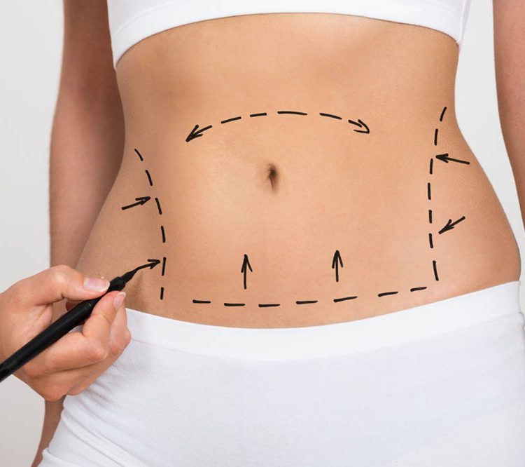 Nuestros procedimientos de liposucción