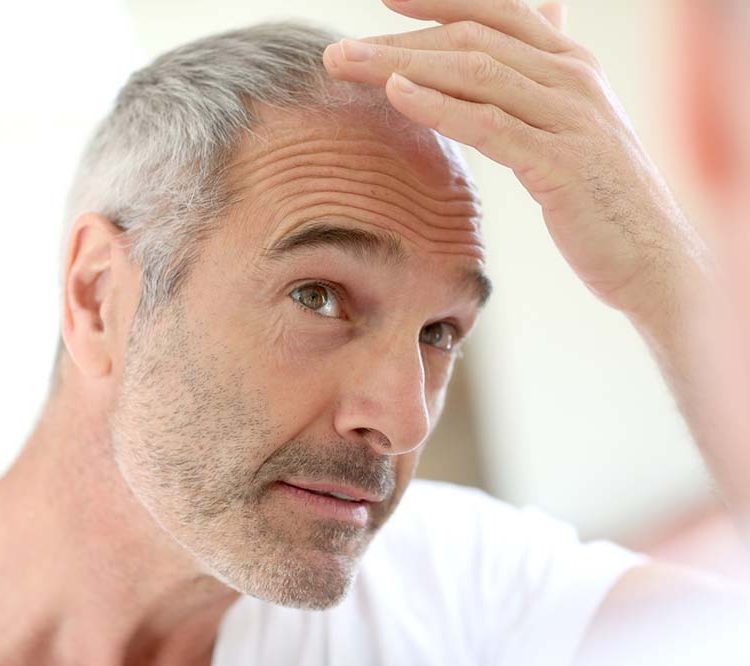Cos’è la terapia dell’alopecia?