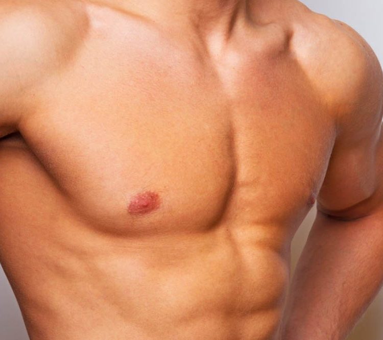 Quais são as causas da ginecomastia?