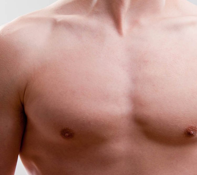 Benefícios para ginecomastia