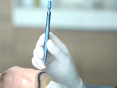 Tehnica FUE cu safir