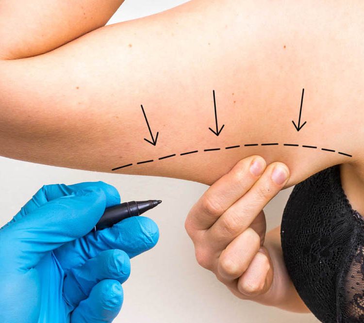 Ridicari de brate: metodele noastre